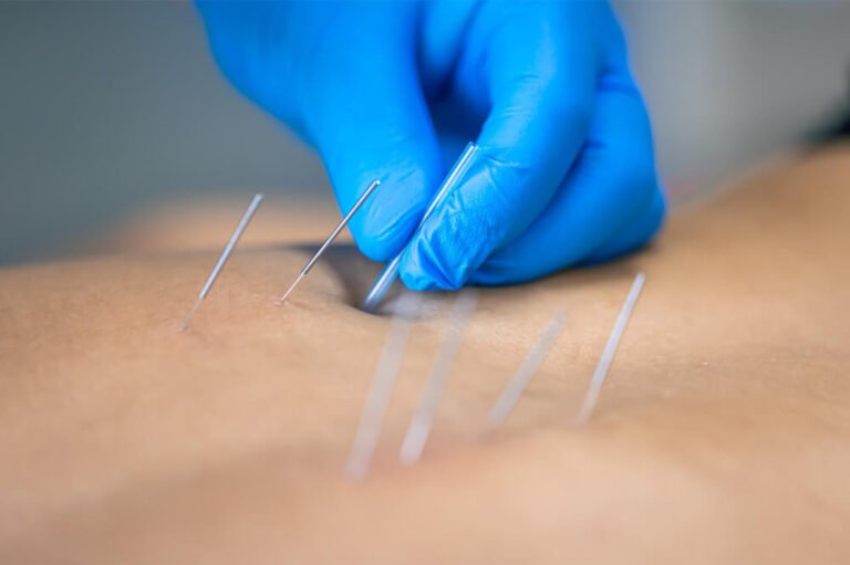 Abdominal Acupuncture