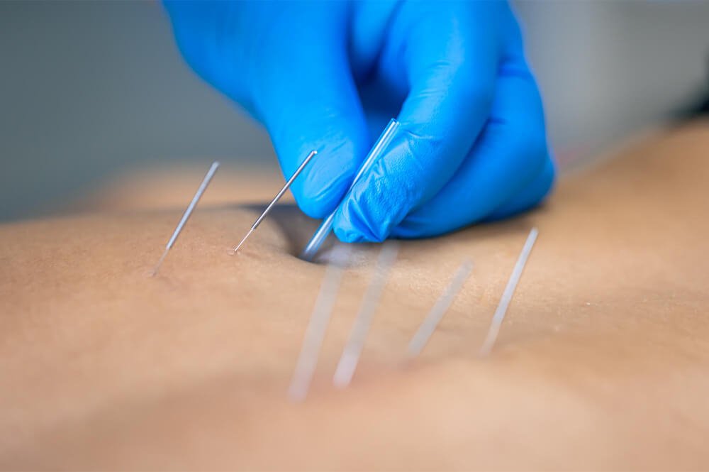 Abdominal Acupuncture