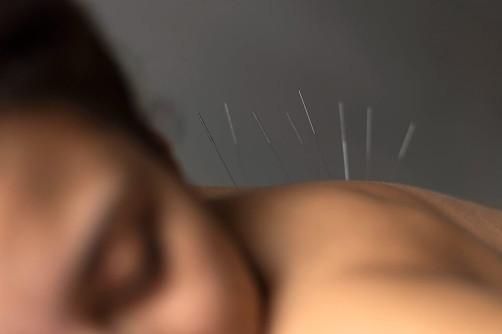 Acupuncture Treatment